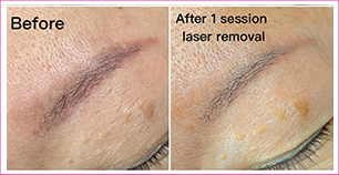 Zero Invasive Laser Removal
